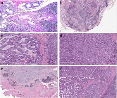 An Unusual Salivary Gland Tumor Mimicking Papillary Thyroid Carcinoma: Mammary Analog Secretory Carcinoma